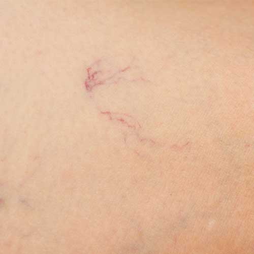 image of the Spider Veins and Varicose Veins treatment